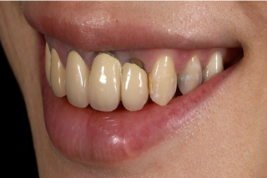 بعد تركيبات-اسنان