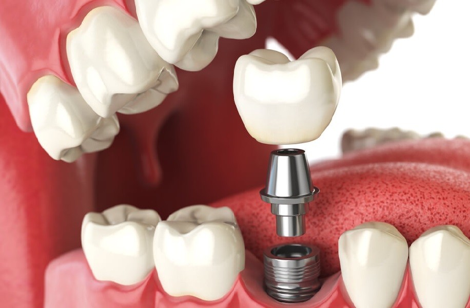 هل زراعة الأسنان تدوم مدى الحياة