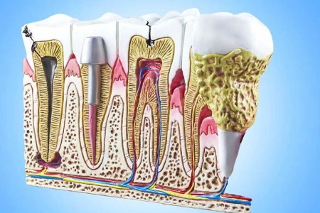 Root Canal Treatment