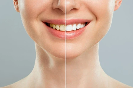 حالات تبيض ليزر